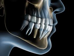 Radiografii 3D CRANEX3D